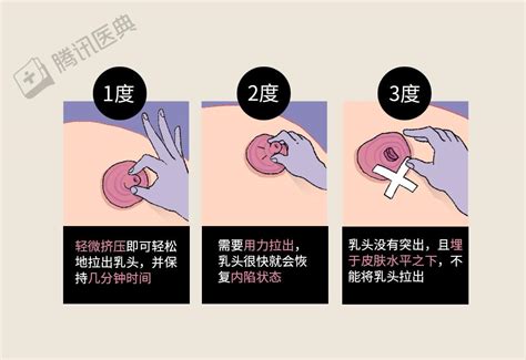 乳暈生毛|乳頭邊長了毛，是什麼病？該不該拔？讓名醫一次解釋給您聽｜每